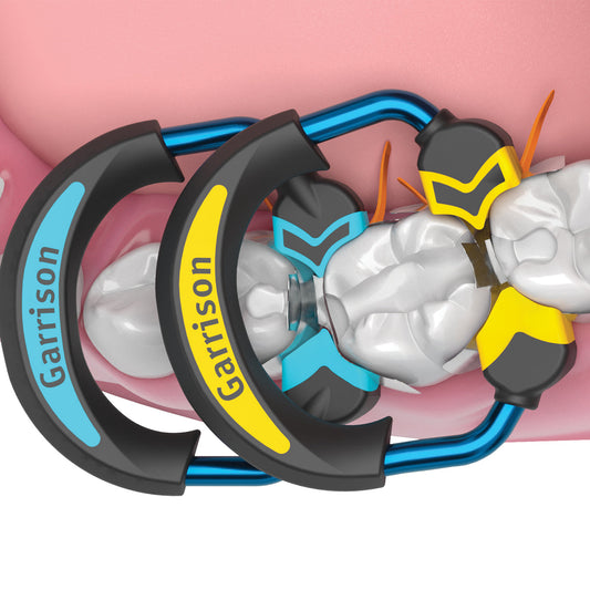 Quad Sectional Matrix System™ for Back-to-Back Class II's