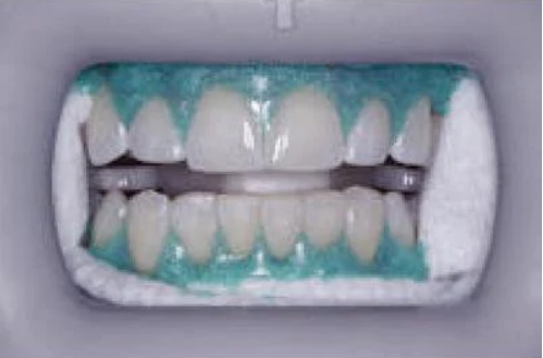Barrière gingivale VENUS WHITE Max Lt. Cure n° 40005202 (Kulzer)